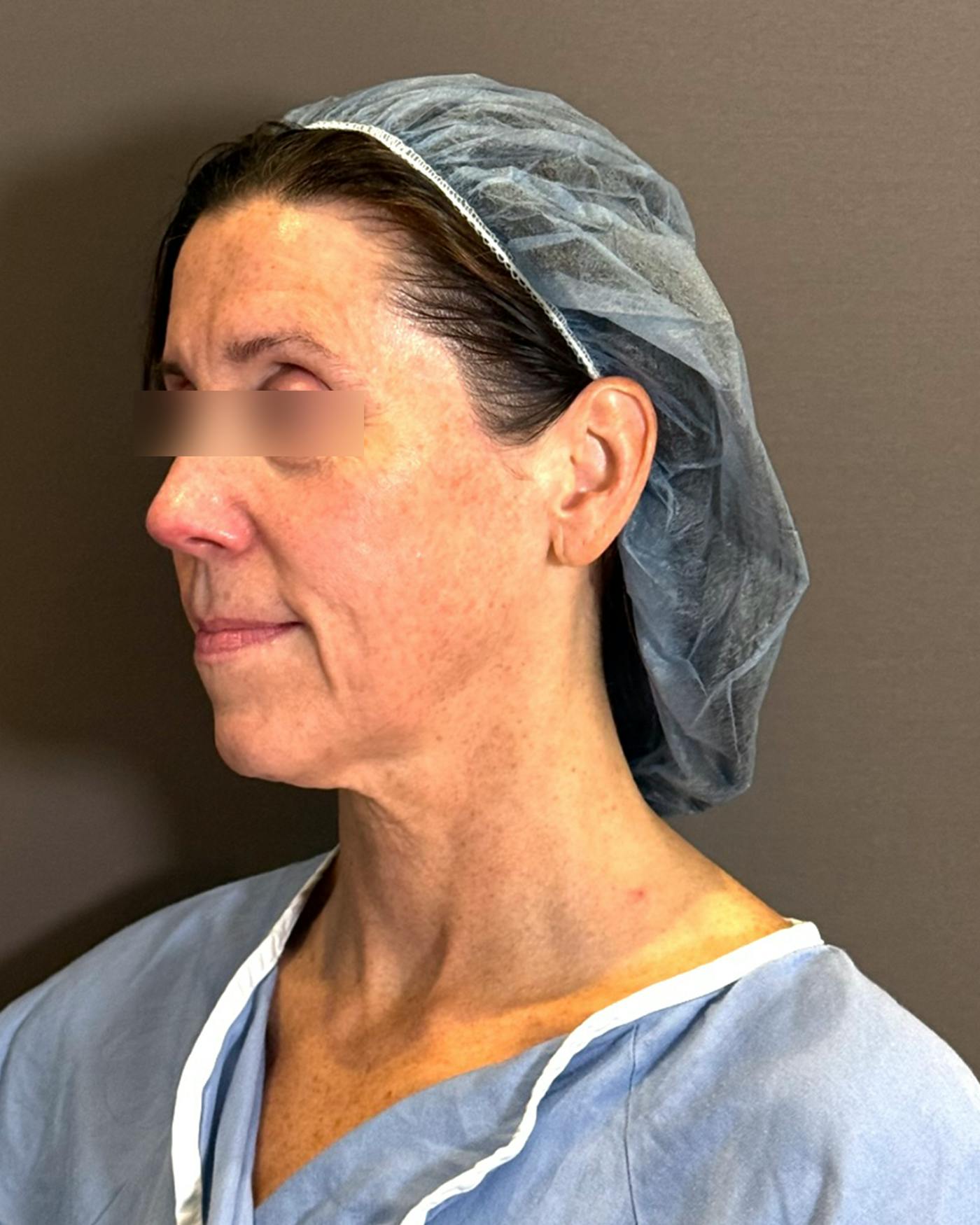 Facelifts / Necklift Before & After Gallery - Patient 836644 - Image 1