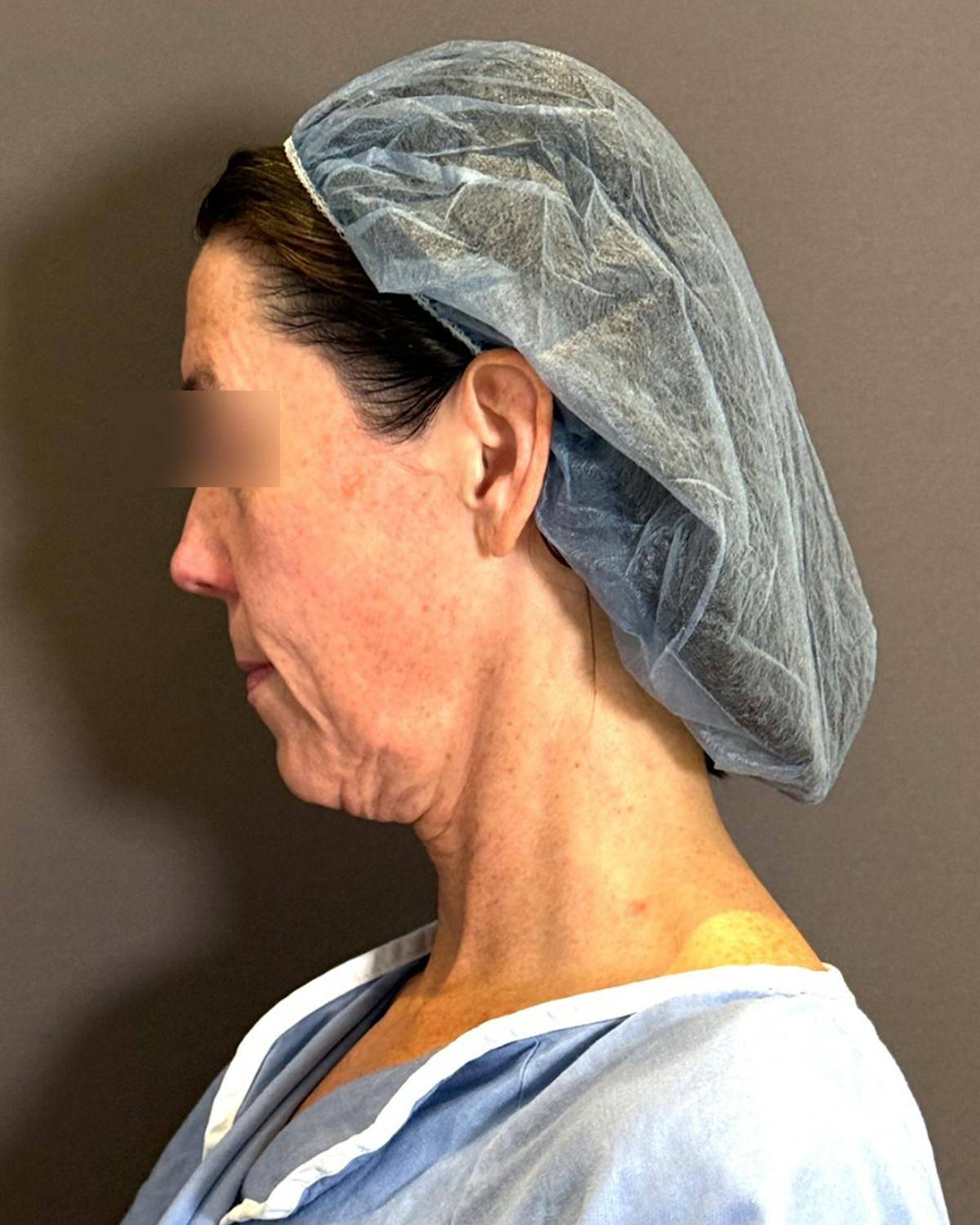 Facelift & Necklift before in NYC, patient 836644