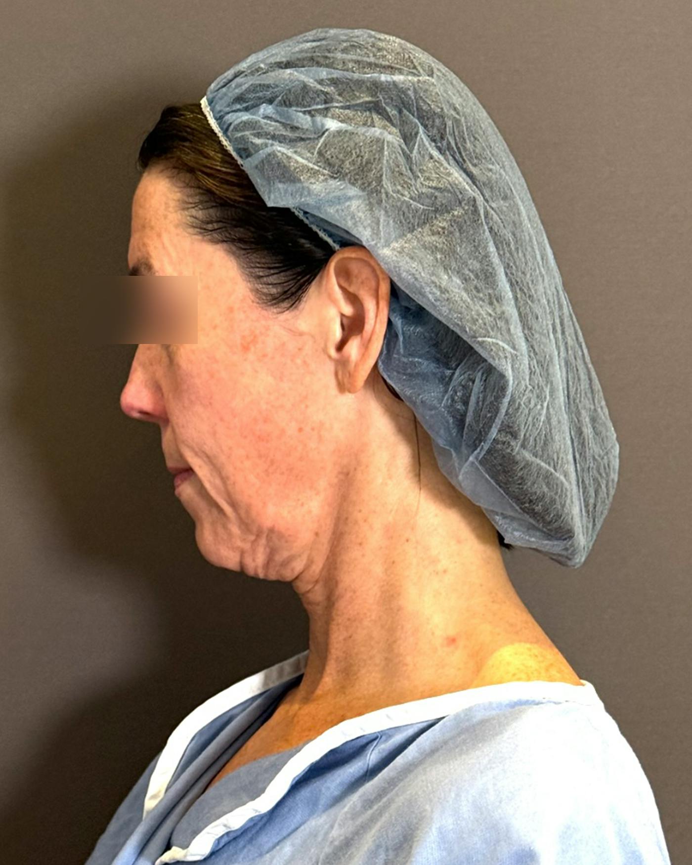 Facelifts / Necklift Before & After Gallery - Patient 836644 - Image 3