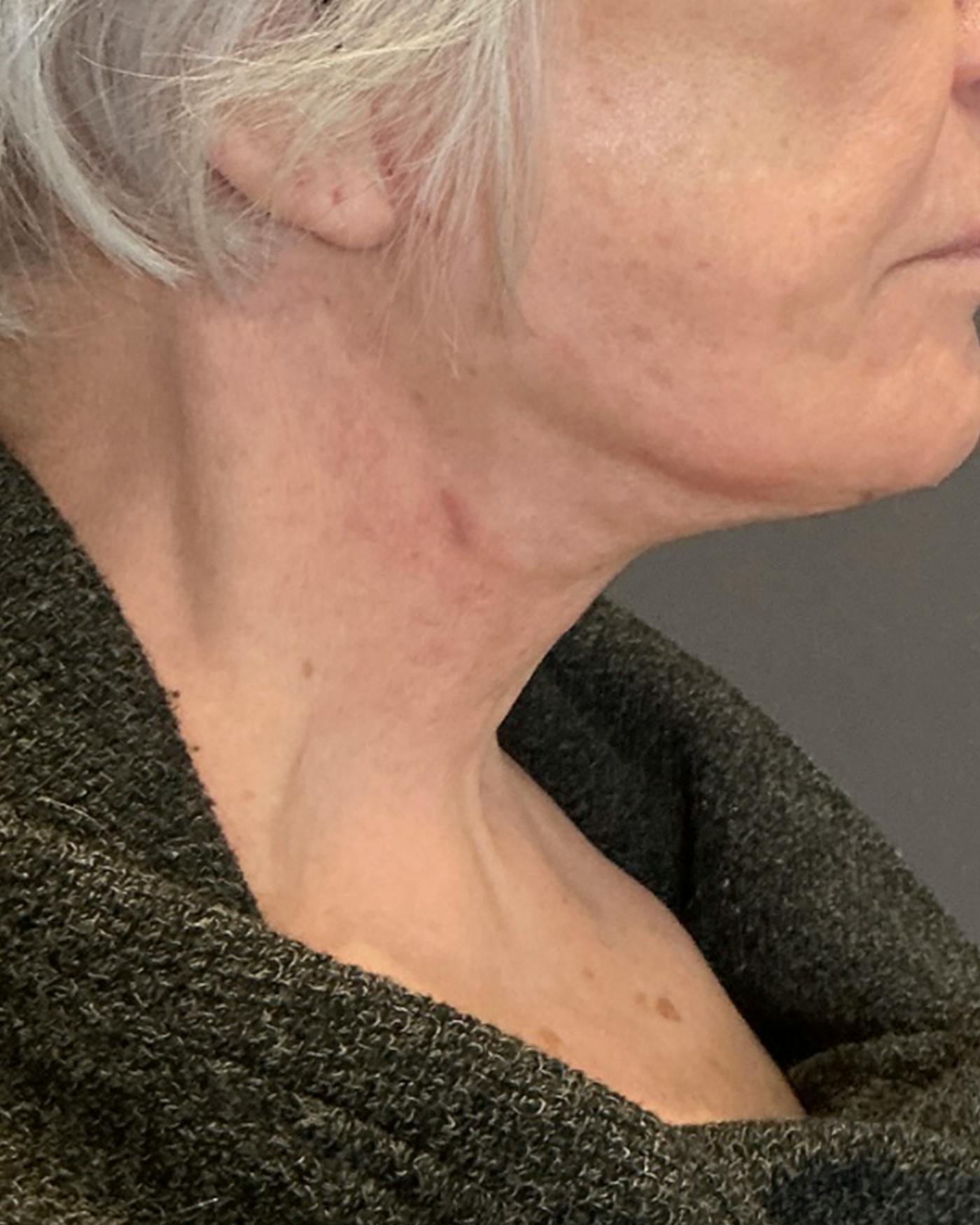 Facelifts / Necklift Before & After Gallery - Patient 394104 - Image 2