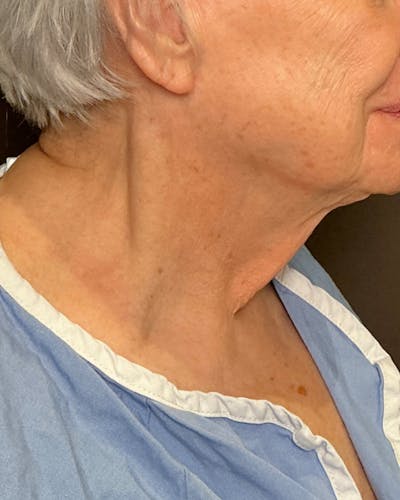 Facelifts / Necklift Before & After Gallery - Patient 394104 - Image 1