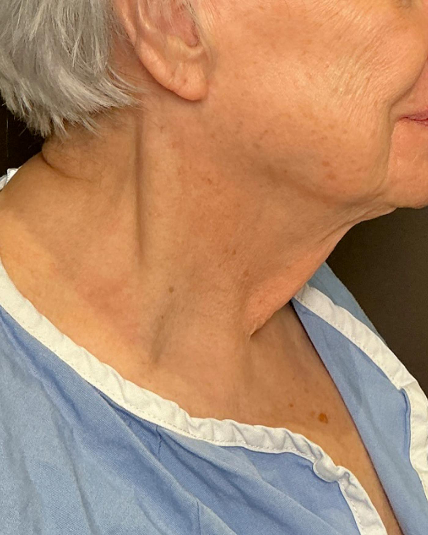 Facelifts / Necklift Before & After Gallery - Patient 394104 - Image 1