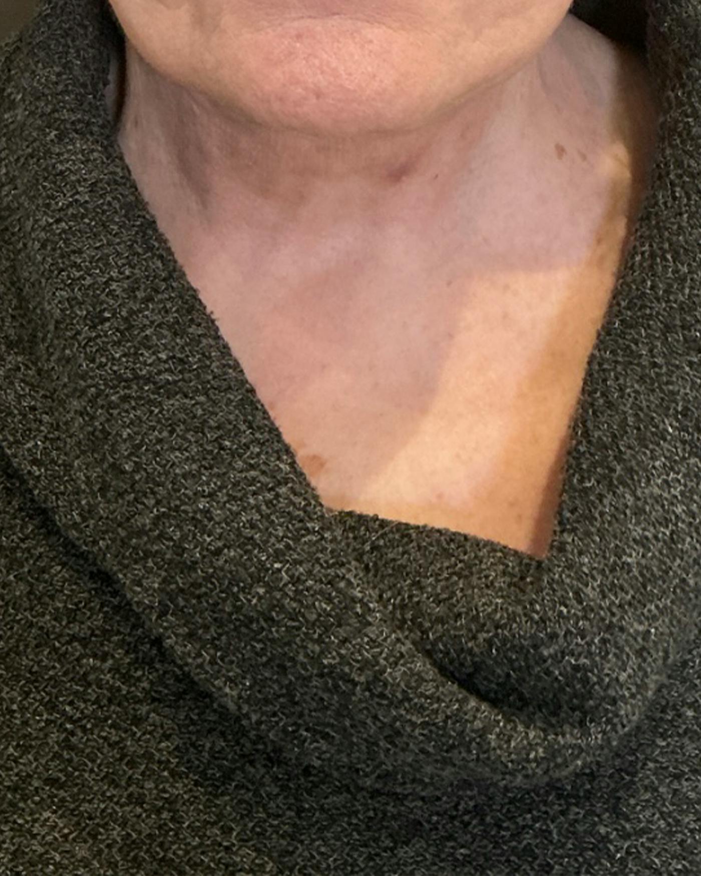 Facelifts / Necklift Before & After Gallery - Patient 394104 - Image 4