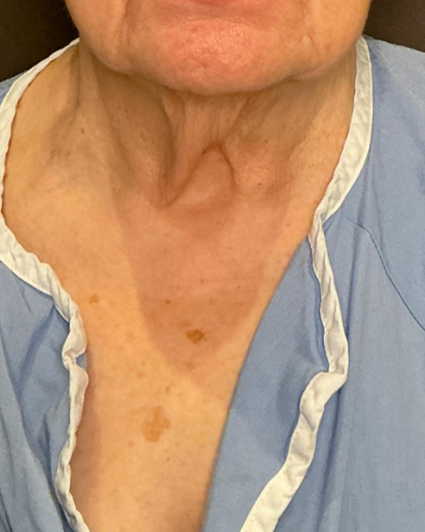 Facelifts / Necklift Before & After Gallery - Patient 394104 - Image 3