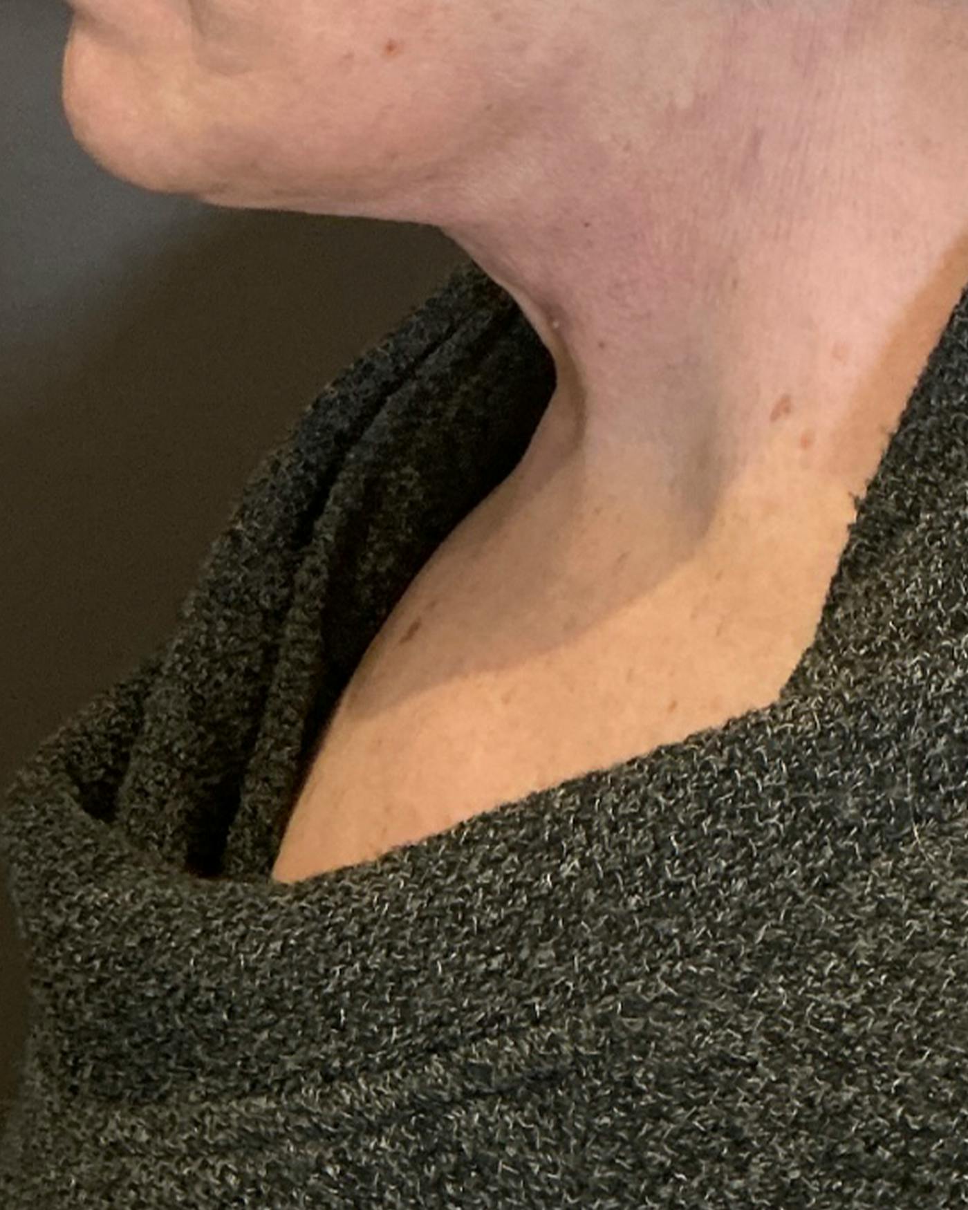 Facelifts / Necklift Before & After Gallery - Patient 394104 - Image 6