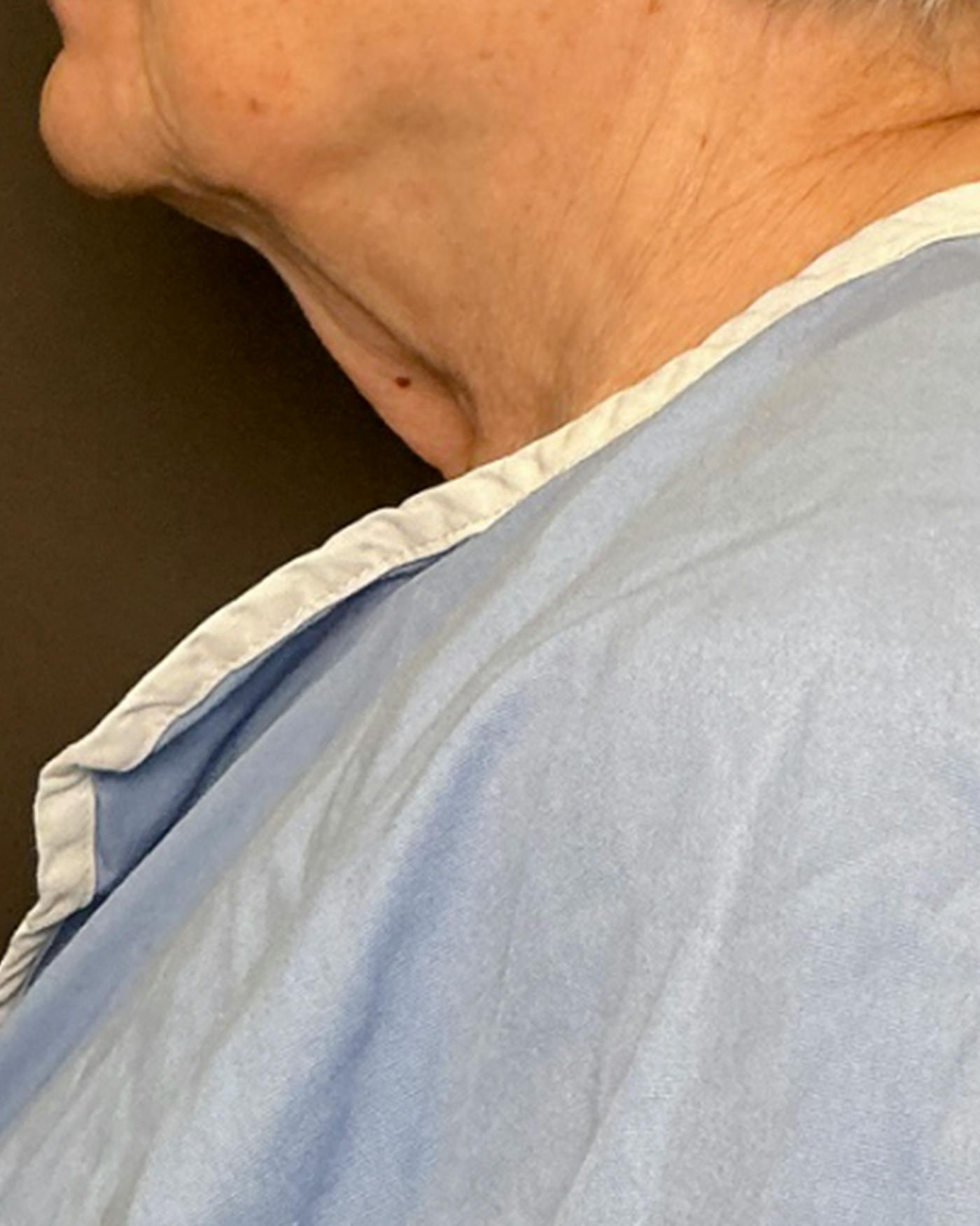 Facelifts / Necklift Before & After Gallery - Patient 394104 - Image 5