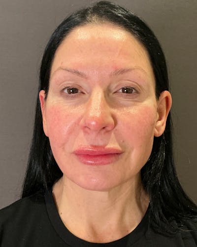 Nanolift Before & After Gallery - Patient 253738 - Image 1