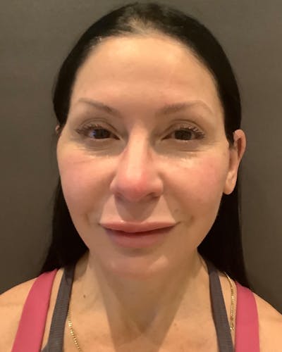 Nanolift Before & After Gallery - Patient 253738 - Image 2