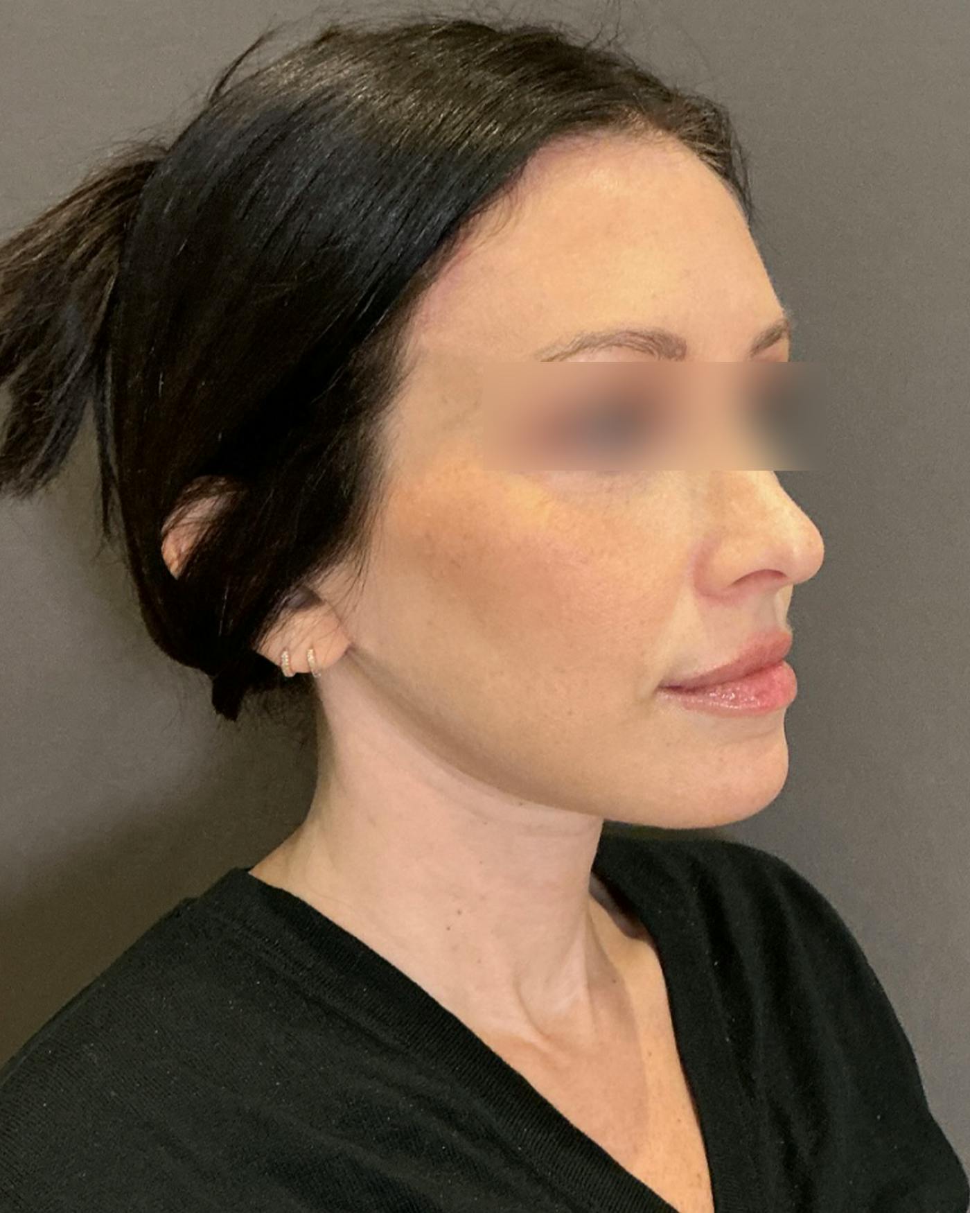 Facelifts / Necklift Before & After Gallery - Patient 852538 - Image 2