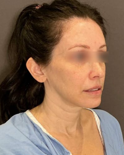 Facelifts / Necklift Before & After Gallery - Patient 852538 - Image 1