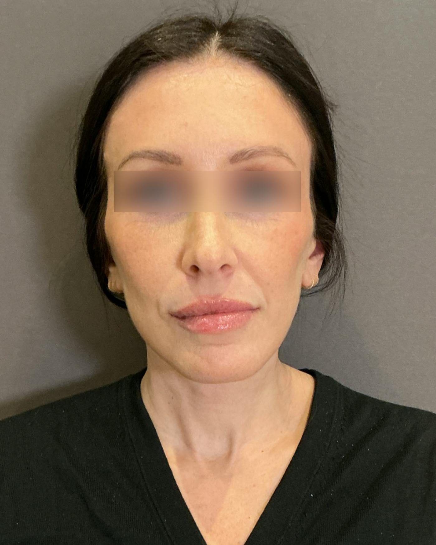 Facelifts / Necklift Before & After Gallery - Patient 852538 - Image 6