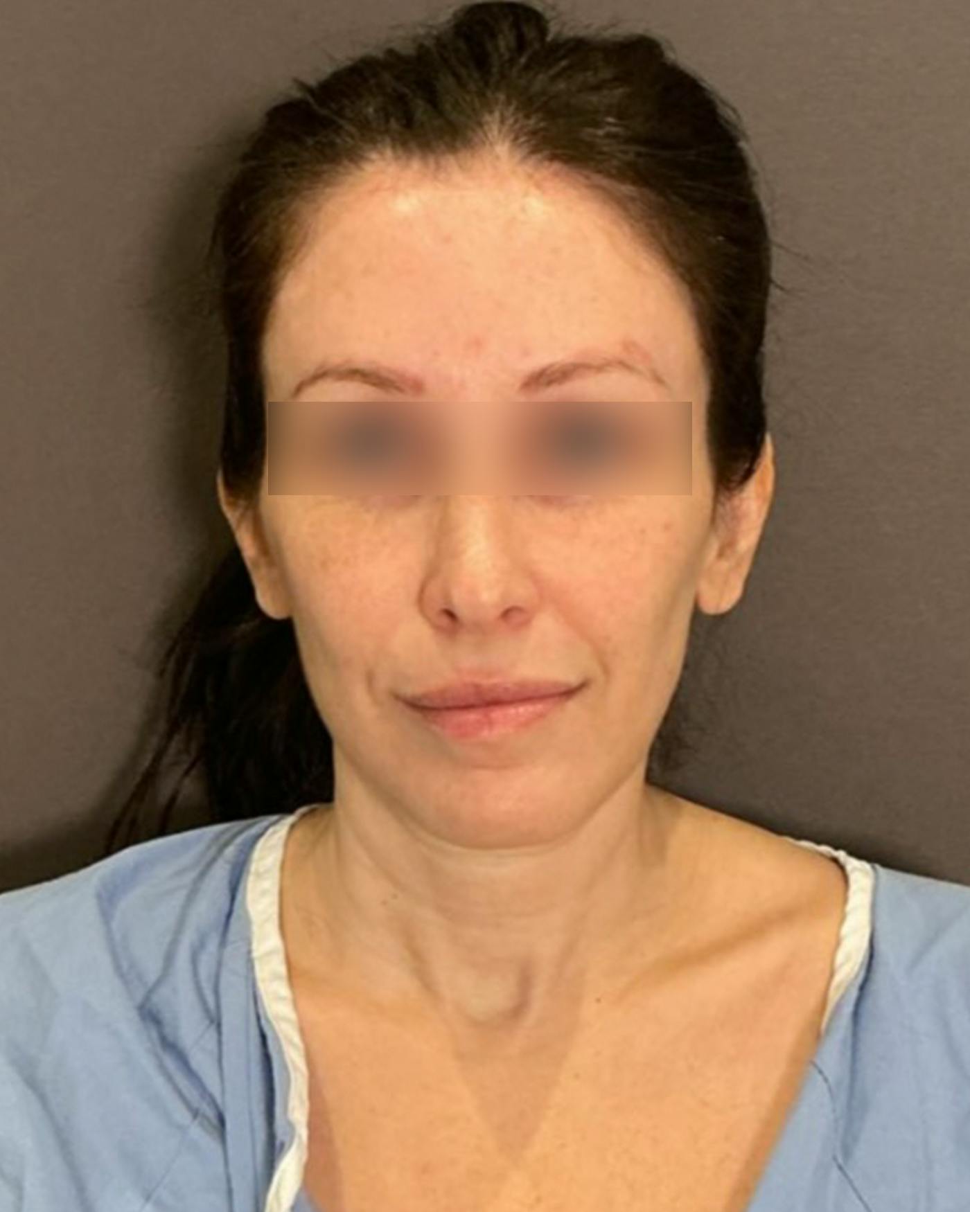 Facelifts / Necklift Before & After Gallery - Patient 852538 - Image 5
