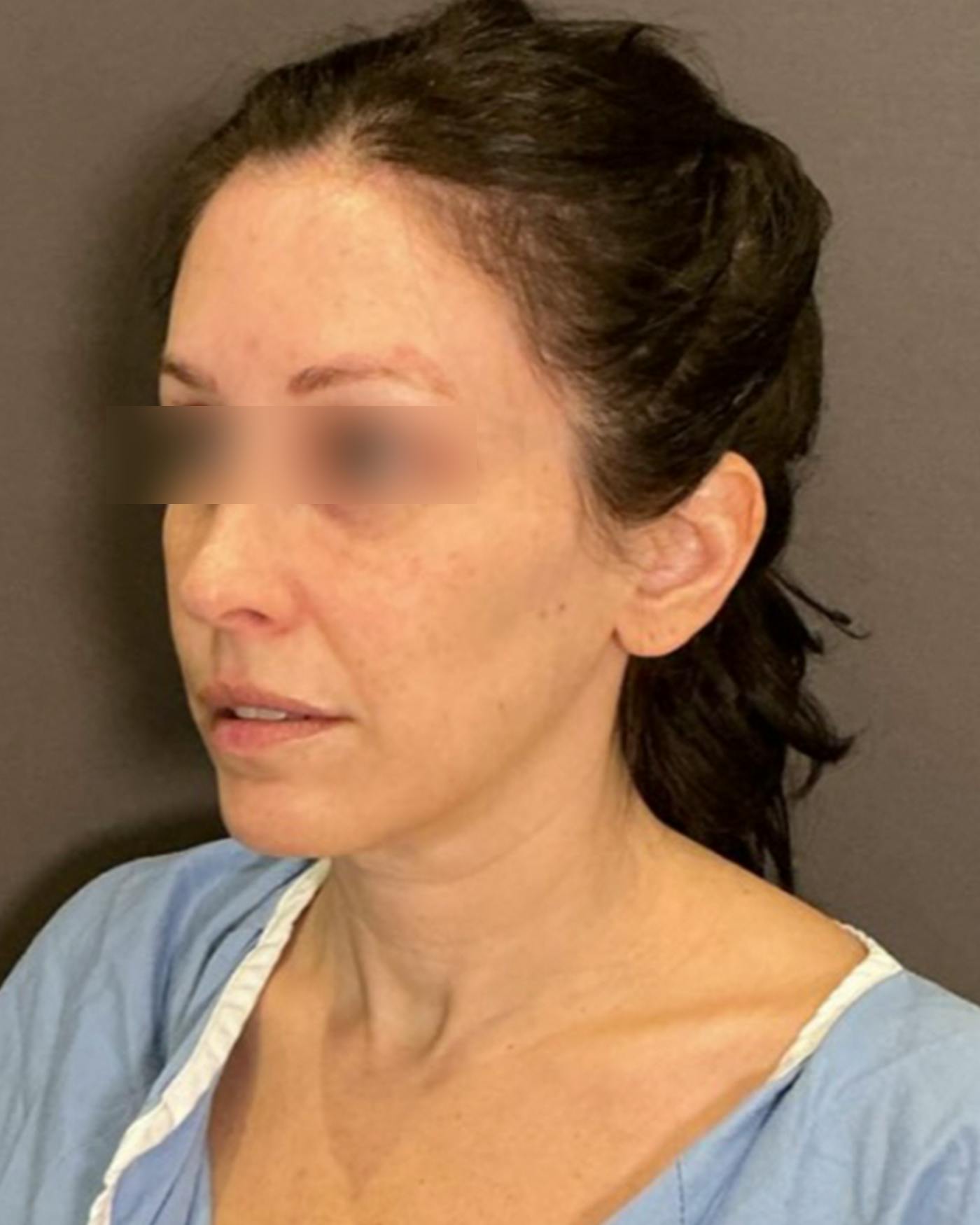 Facelifts / Necklift Before & After Gallery - Patient 852538 - Image 7