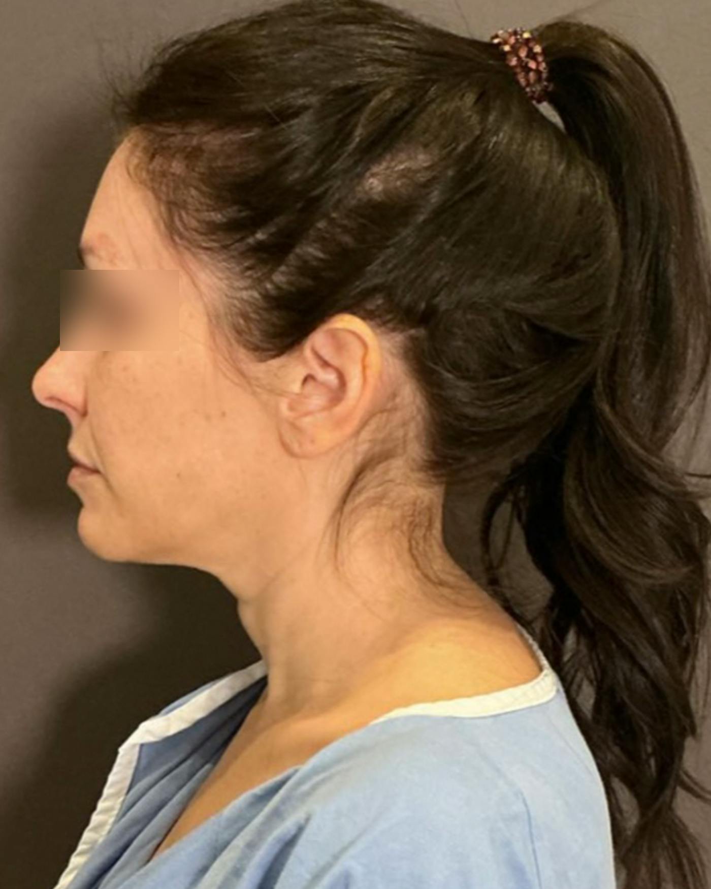 Facelifts / Necklift Before & After Gallery - Patient 852538 - Image 9