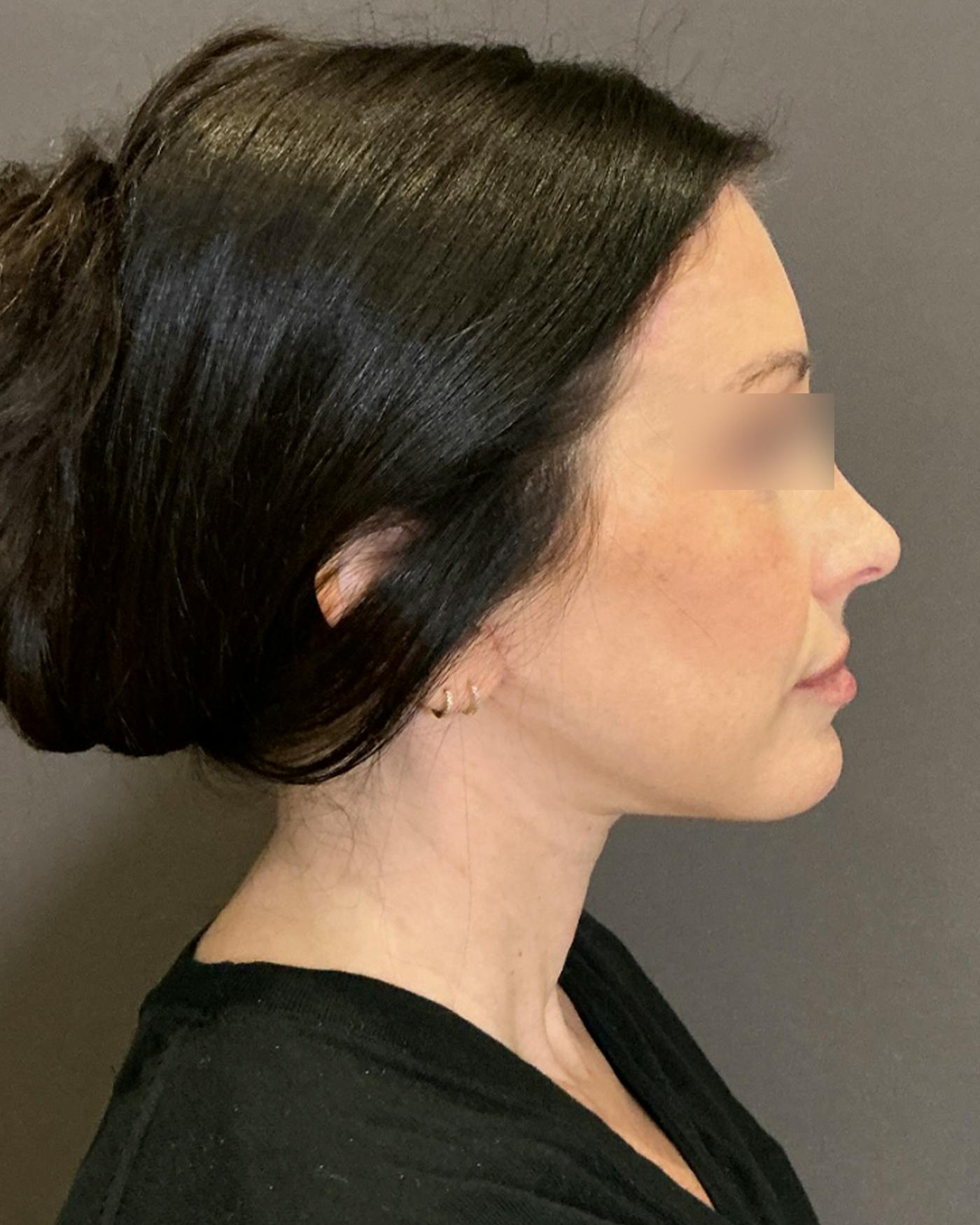 Facelifts / Necklift Before & After Gallery - Patient 852538 - Image 4