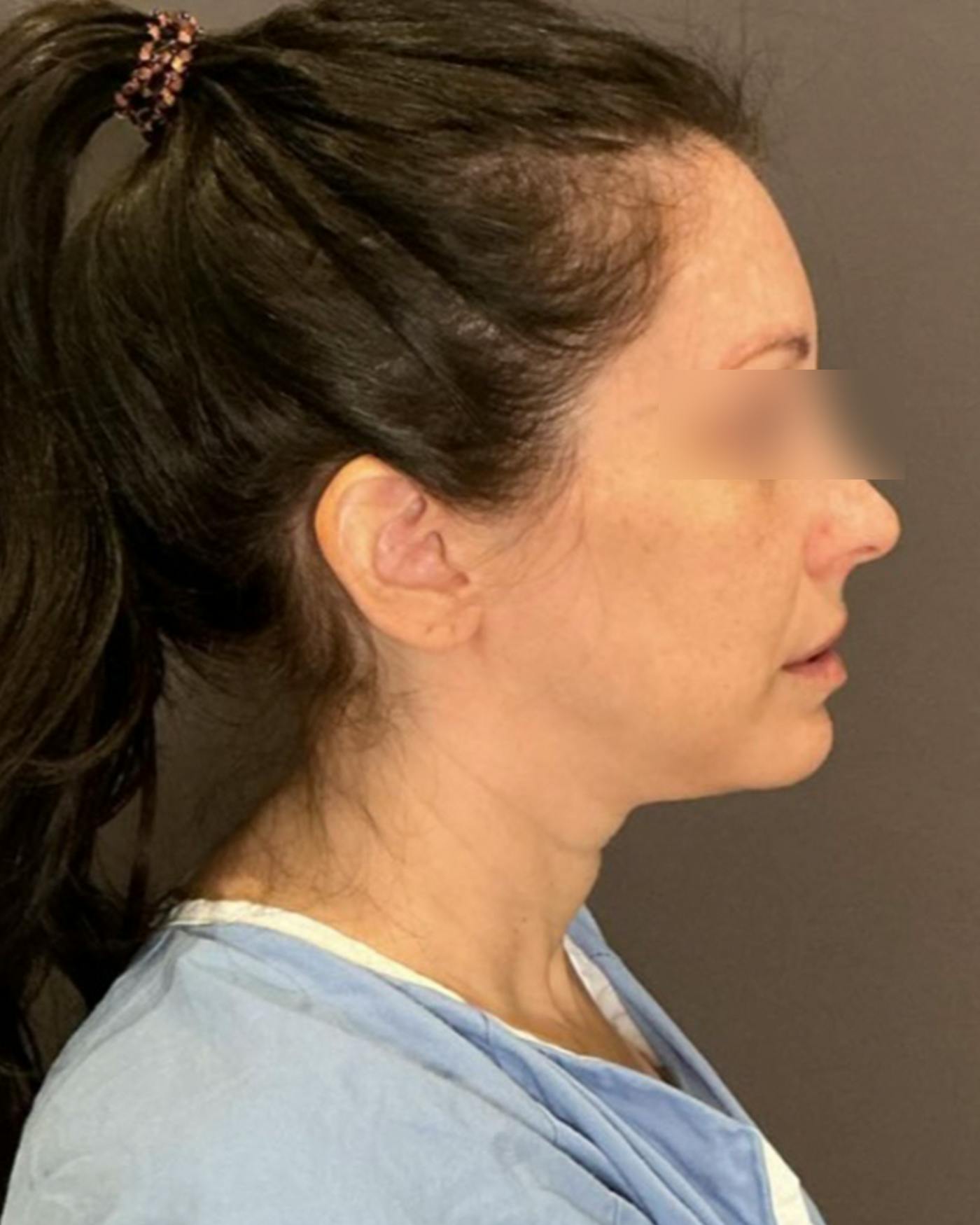 Facelifts / Necklift Before & After Gallery - Patient 852538 - Image 3
