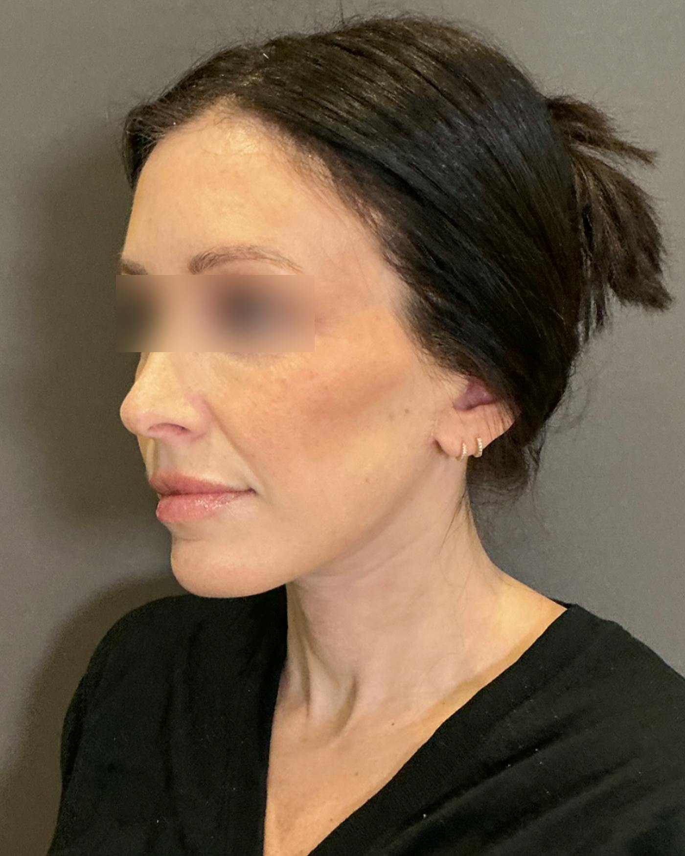 Facelifts / Necklift Before & After Gallery - Patient 852538 - Image 8