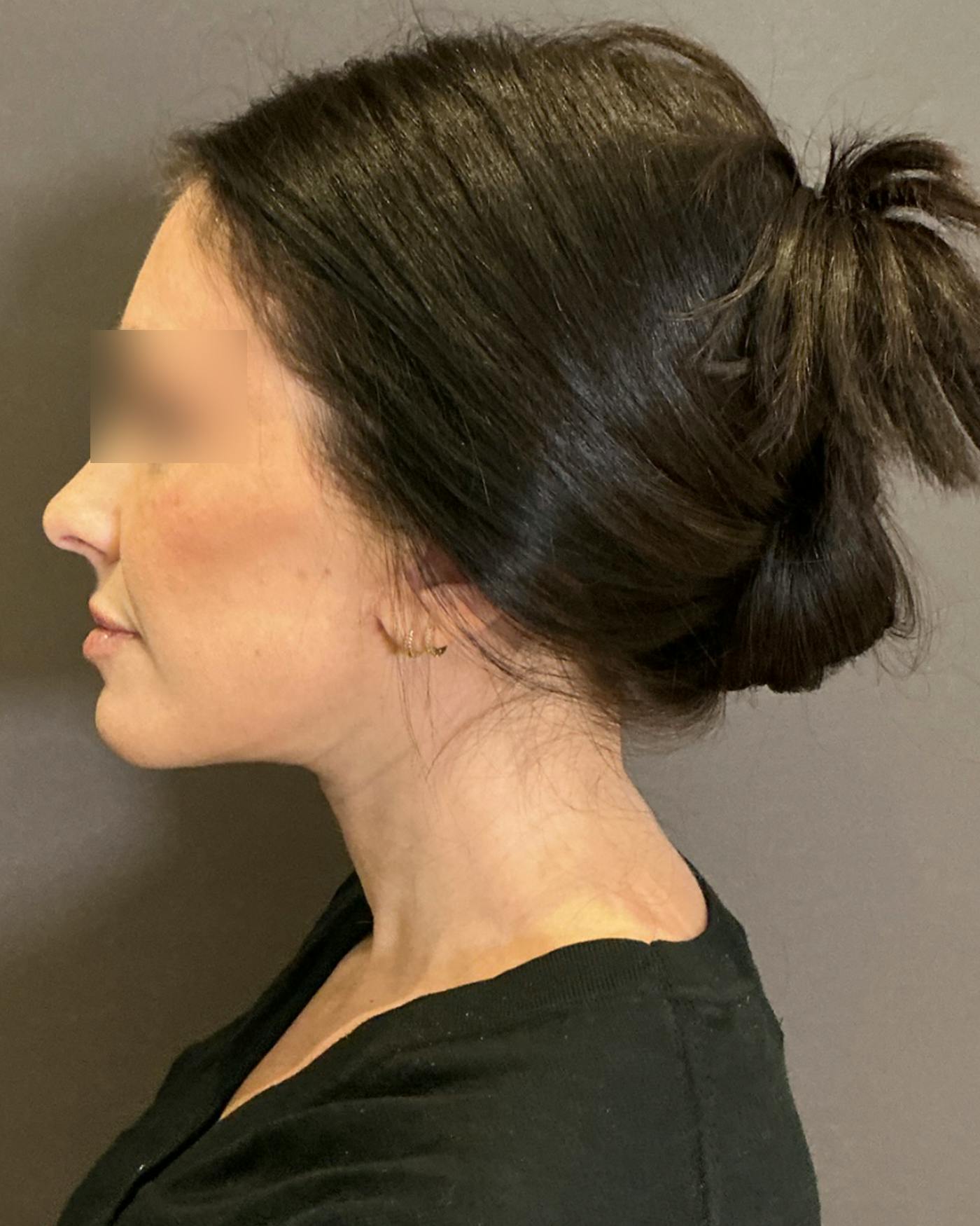 Facelifts / Necklift Before & After Gallery - Patient 852538 - Image 10