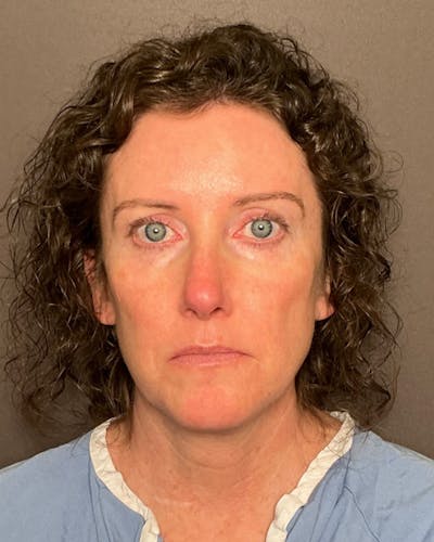 Facelifts / Necklift Before & After Gallery - Patient 215982 - Image 1