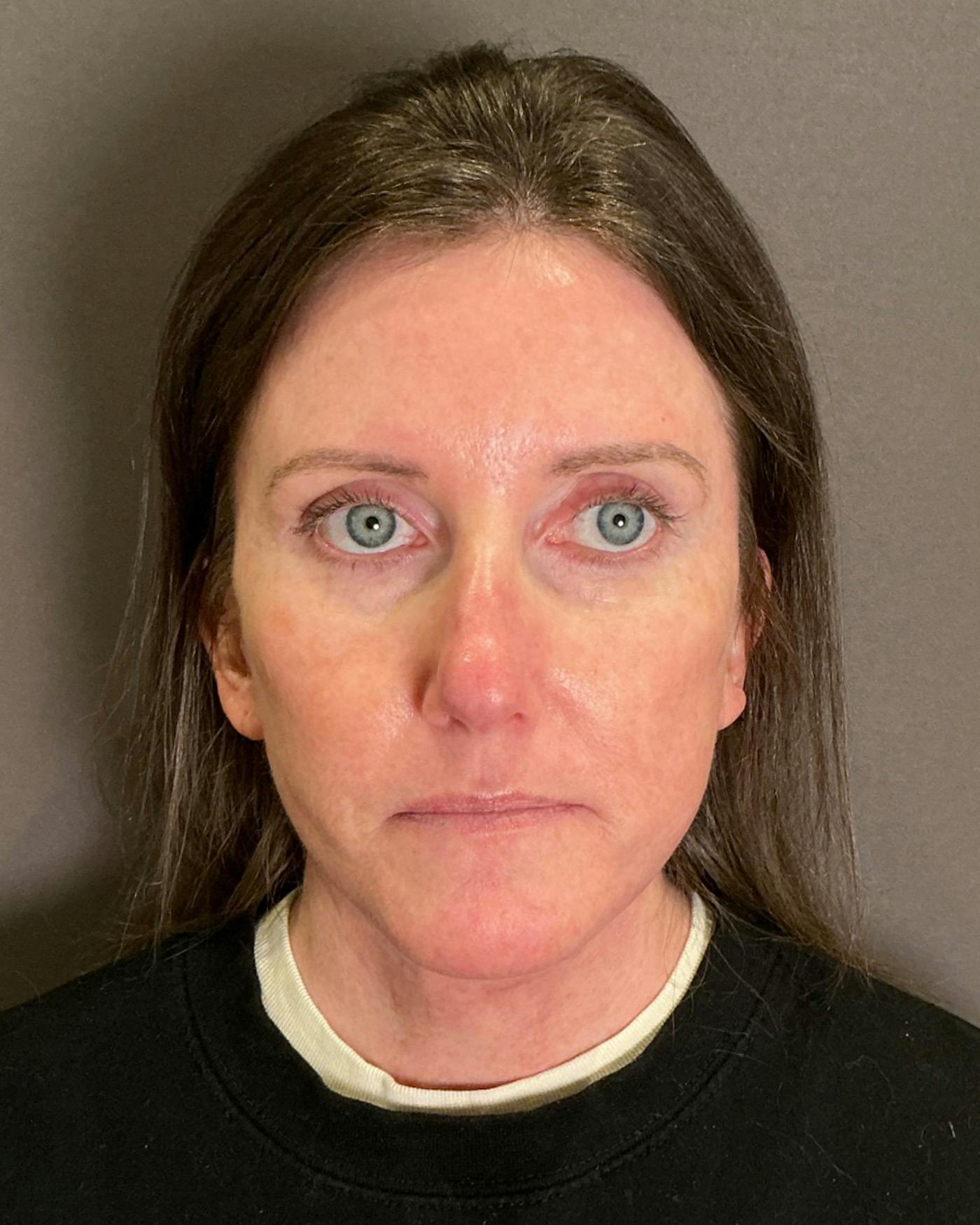 Facelifts / Necklift Before & After Gallery - Patient 215982 - Image 2