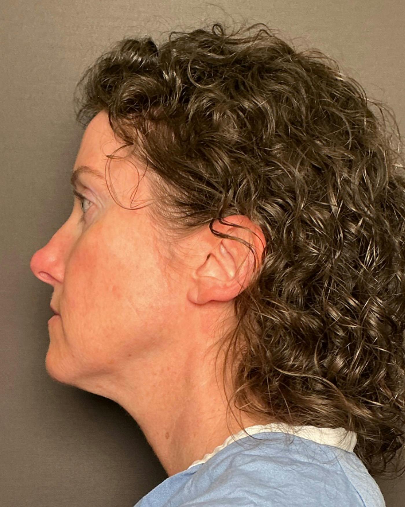Facelifts / Necklift Before & After Gallery - Patient 215982 - Image 3