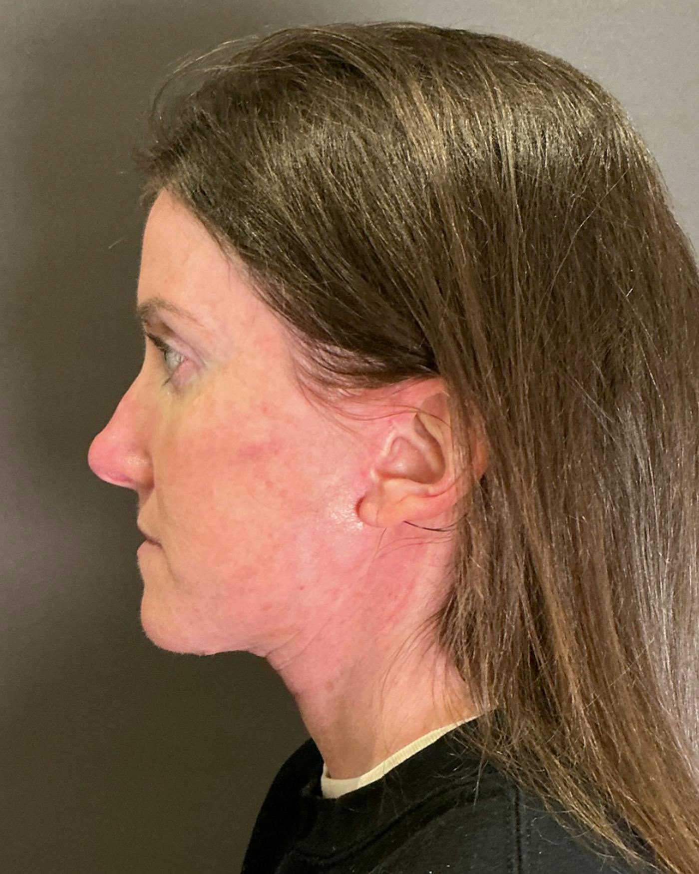 Facelifts / Necklift Before & After Gallery - Patient 215982 - Image 4