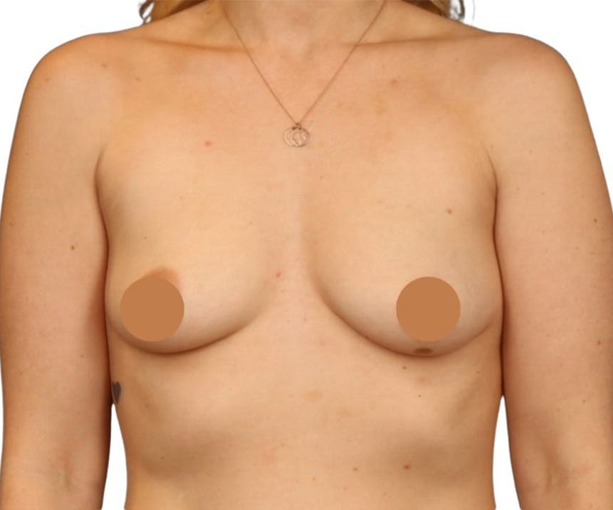 Breast Augmentation Before & After Gallery - Patient 357865 - Image 1