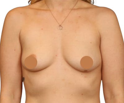 Breast Augmentation Before & After Gallery - Patient 357865 - Image 1