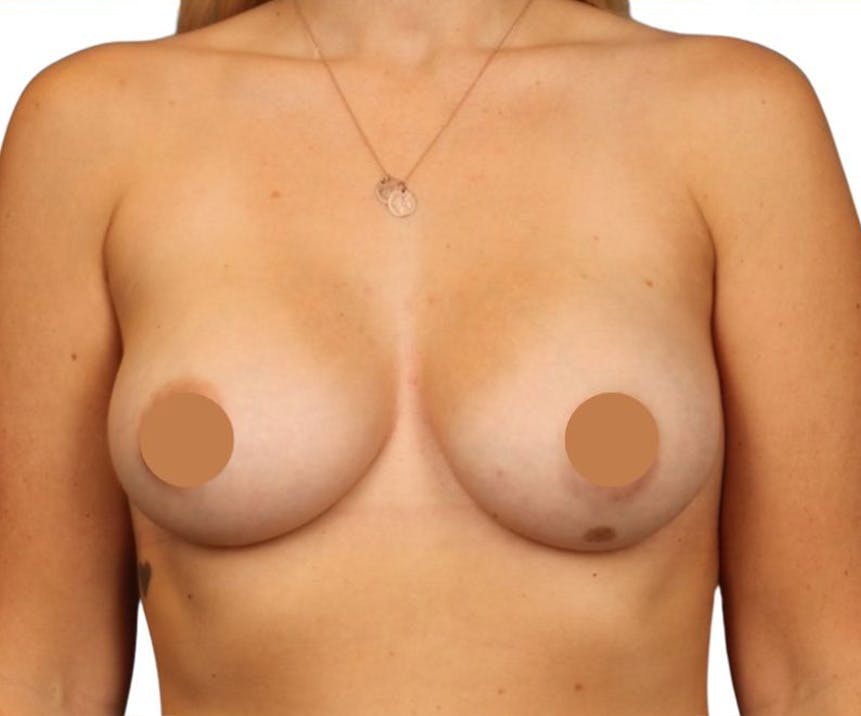 Breast Augmentation Before & After Gallery - Patient 357865 - Image 2