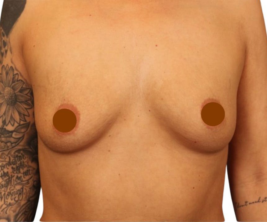 Breast Augmentation Before & After Gallery - Patient 103791 - Image 1