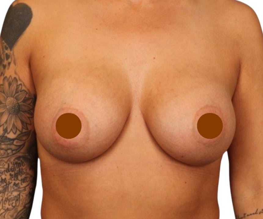 Breast Augmentation Before & After Gallery - Patient 103791 - Image 2