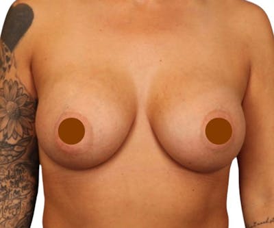 Breast Augmentation Before & After Gallery - Patient 103791 - Image 2