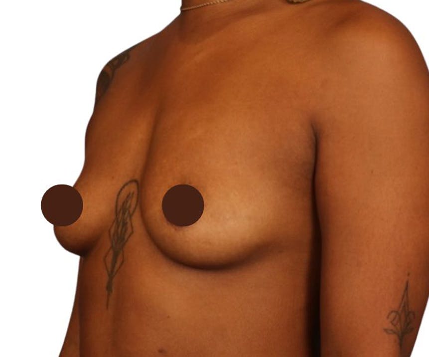 Breast Augmentation Before & After Gallery - Patient 109959 - Image 1