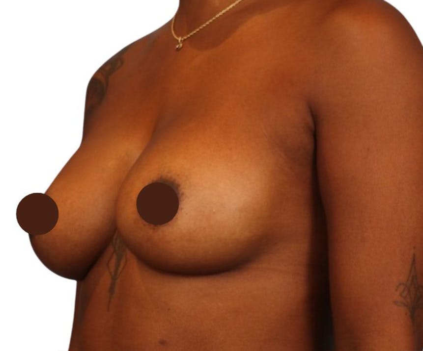 Breast Augmentation Before & After Gallery - Patient 109959 - Image 2