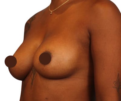 Breast Augmentation Before & After Gallery - Patient 109959 - Image 2