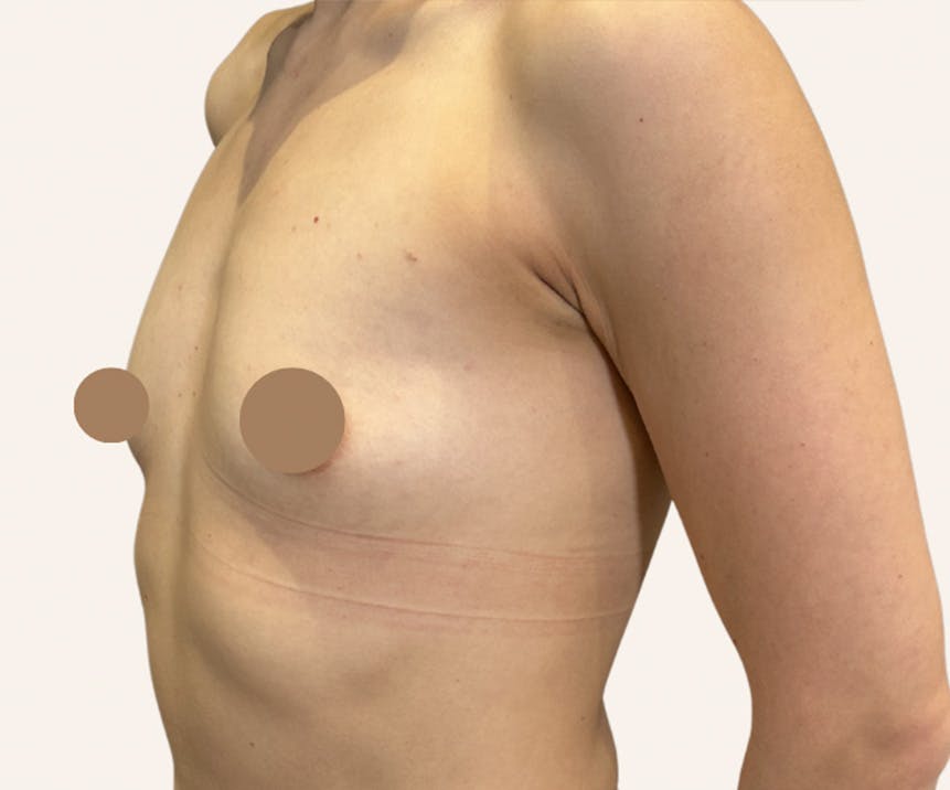 Breast Augmentation Before & After Gallery - Patient 370104 - Image 1