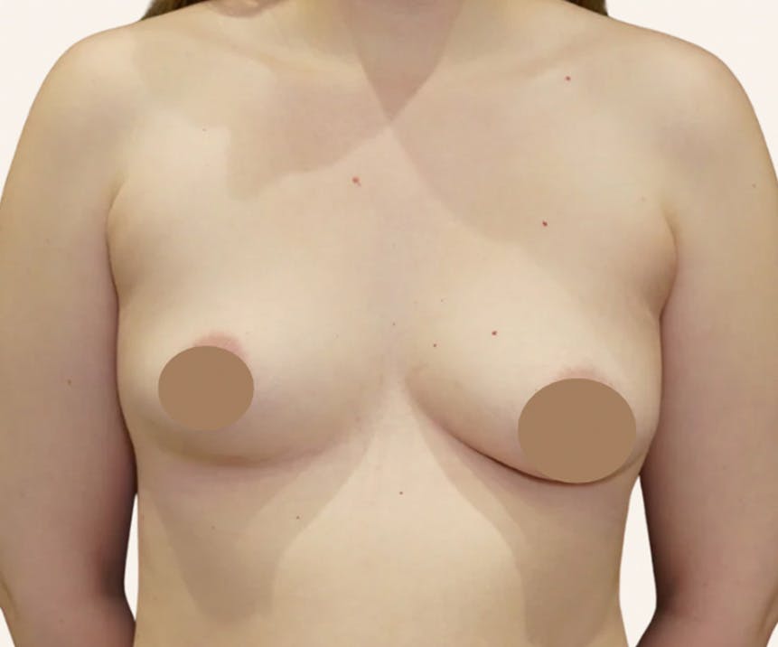 Breast Augmentation Before & After Gallery - Patient 203191 - Image 1