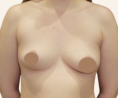 Breast Augmentation Before & After Gallery - Patient 203191 - Image 1