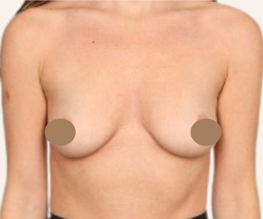 Breast Augmentation Before & After Gallery - Patient 214303 - Image 1