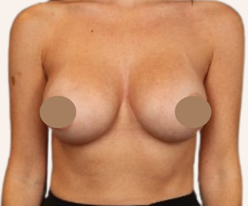 Breast Augmentation Before & After Gallery - Patient 214303 - Image 2