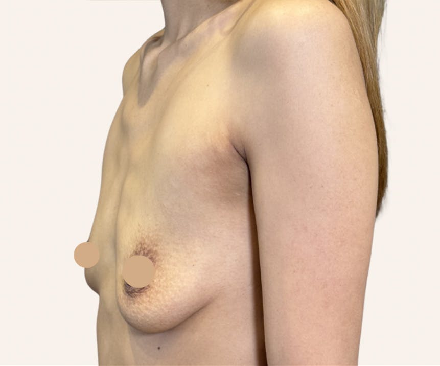 Breast Augmentation Before & After Gallery - Patient 189324 - Image 1