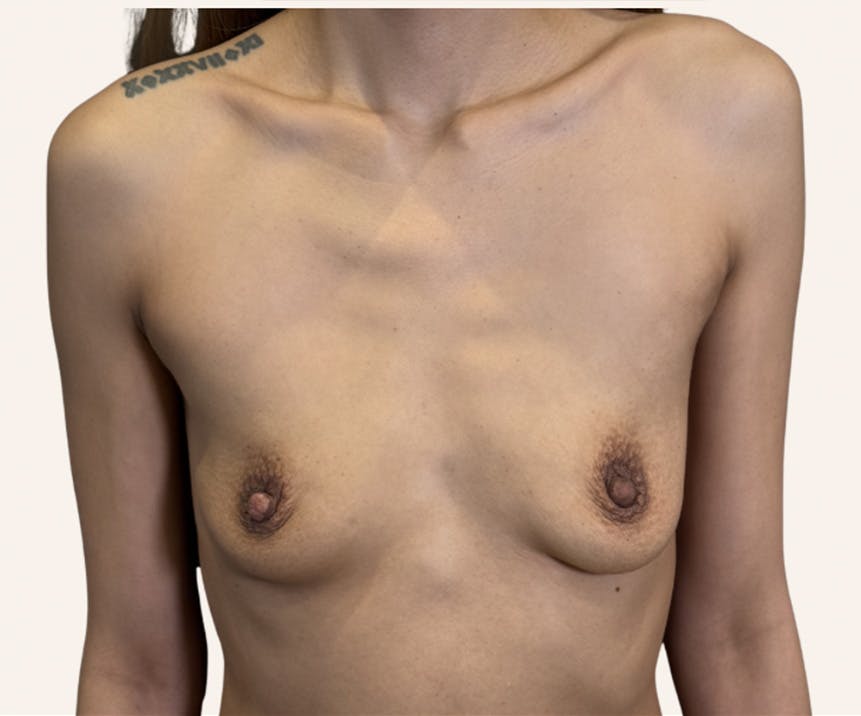 Breast Augmentation Before & After Gallery - Patient 716705 - Image 1