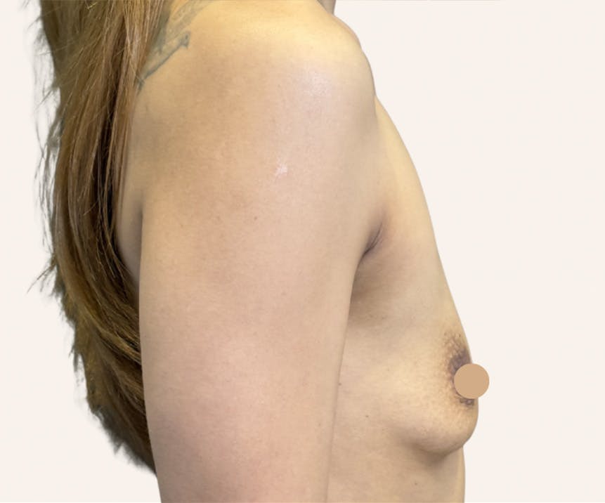Breast Augmentation Before & After Gallery - Patient 203173 - Image 1