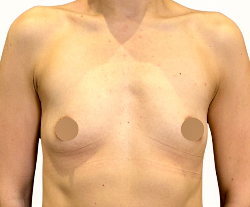 Breast Augmentation Before & After Gallery - Patient 918580 - Image 1