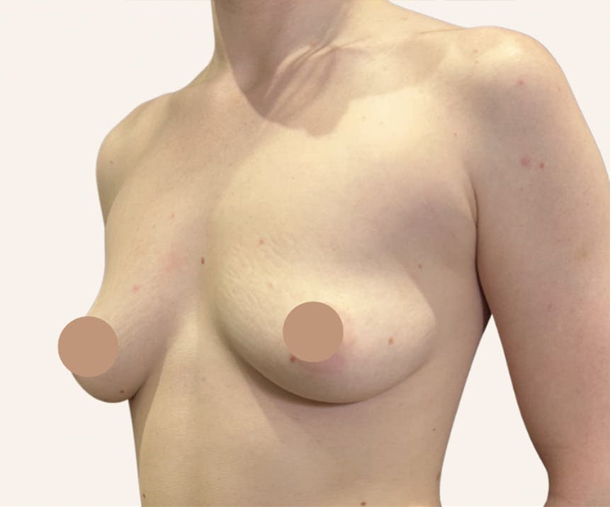 Breast Augmentation Before & After Gallery - Patient 304446 - Image 1