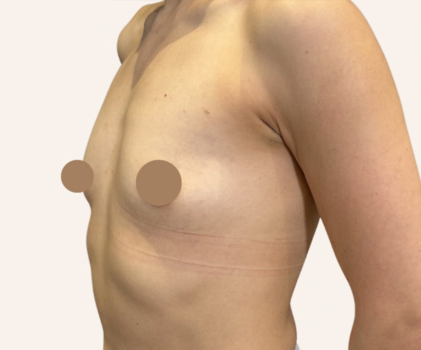 Breast Augmentation Before & After Gallery - Patient 441882 - Image 1