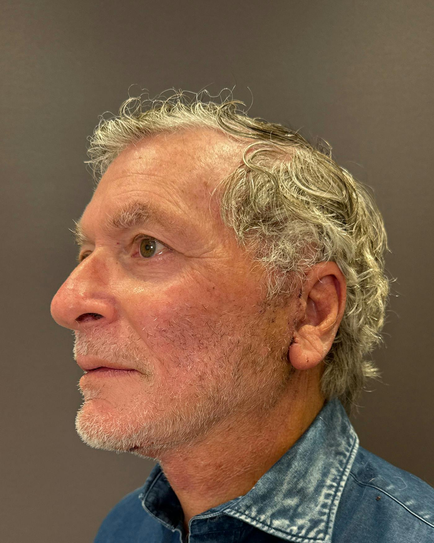 Facial Fat Transfer Before & After Gallery - Patient 244414 - Image 6