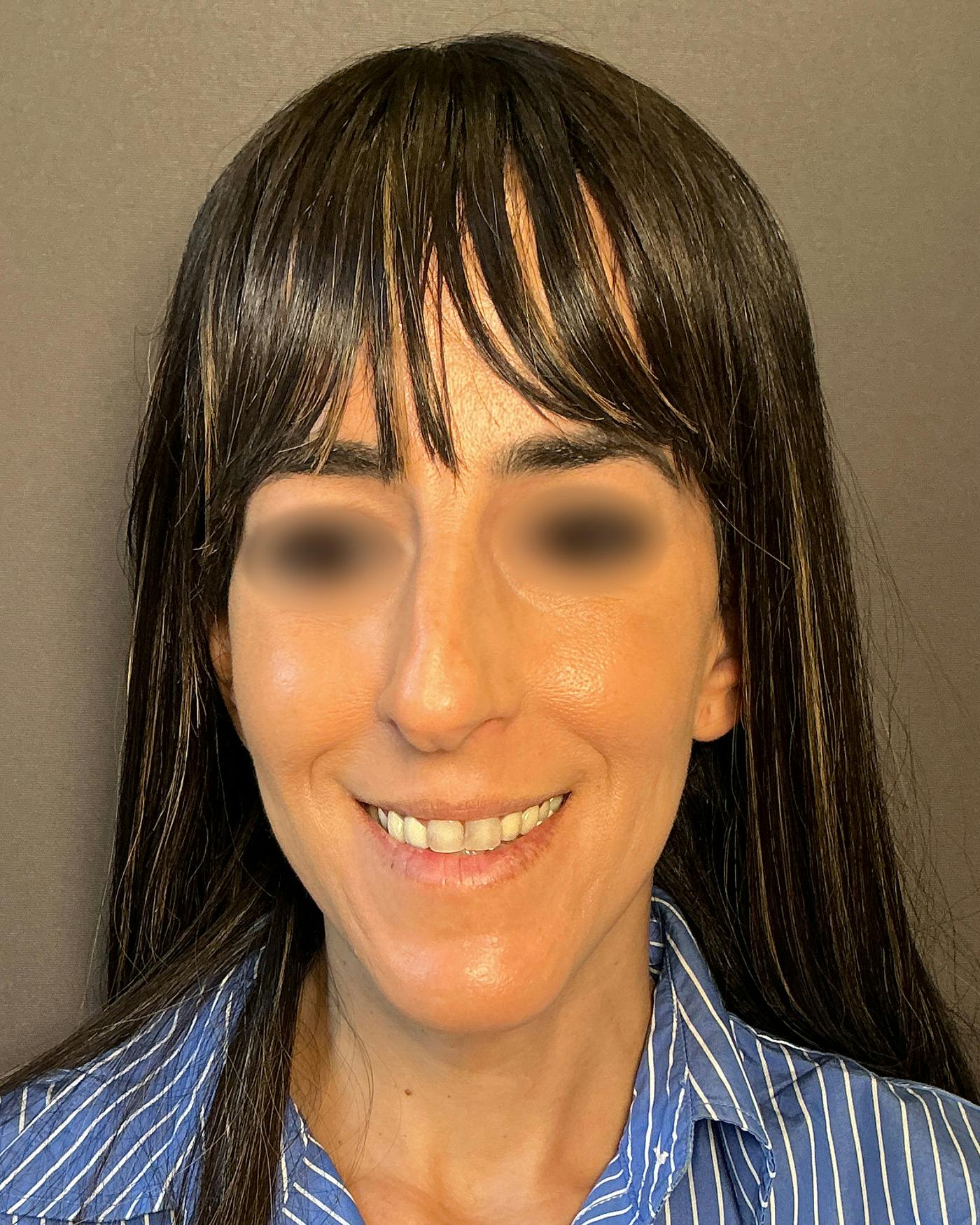 Rhinoplasty Before & After Gallery - Patient 272636 - Image 5