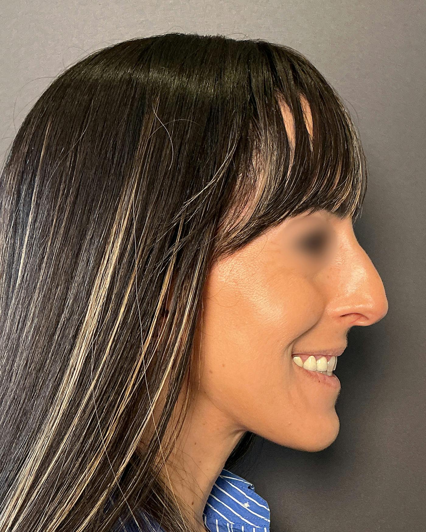Rhinoplasty Before & After Gallery - Patient 272636 - Image 1