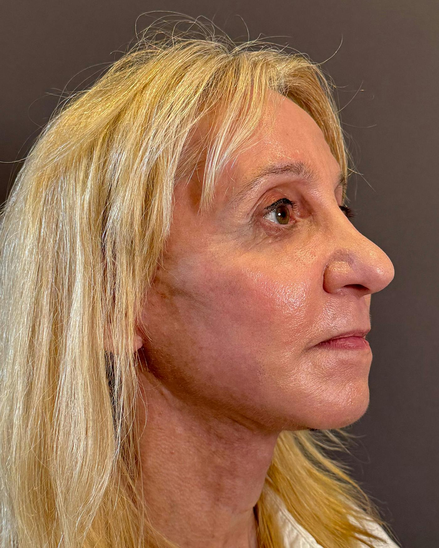 Facelifts / Necklift Before & After Gallery - Patient 506655 - Image 2